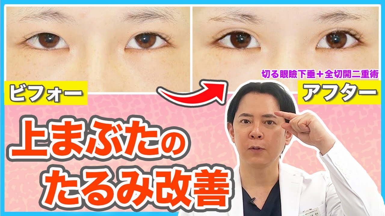 【上まぶたのたるみ改善】眉下切開と眼瞼下垂とこめかみリフトを比較解説 - YouTube