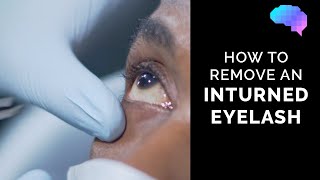 How To Remove An Inturned Eyelash | Eyelash Epilation | Eye First Aid | Osce Guide | Ukmla | Cpsa