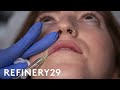 I Got Lip Filler Injections For The First Time | Macro Beauty | Refinery29