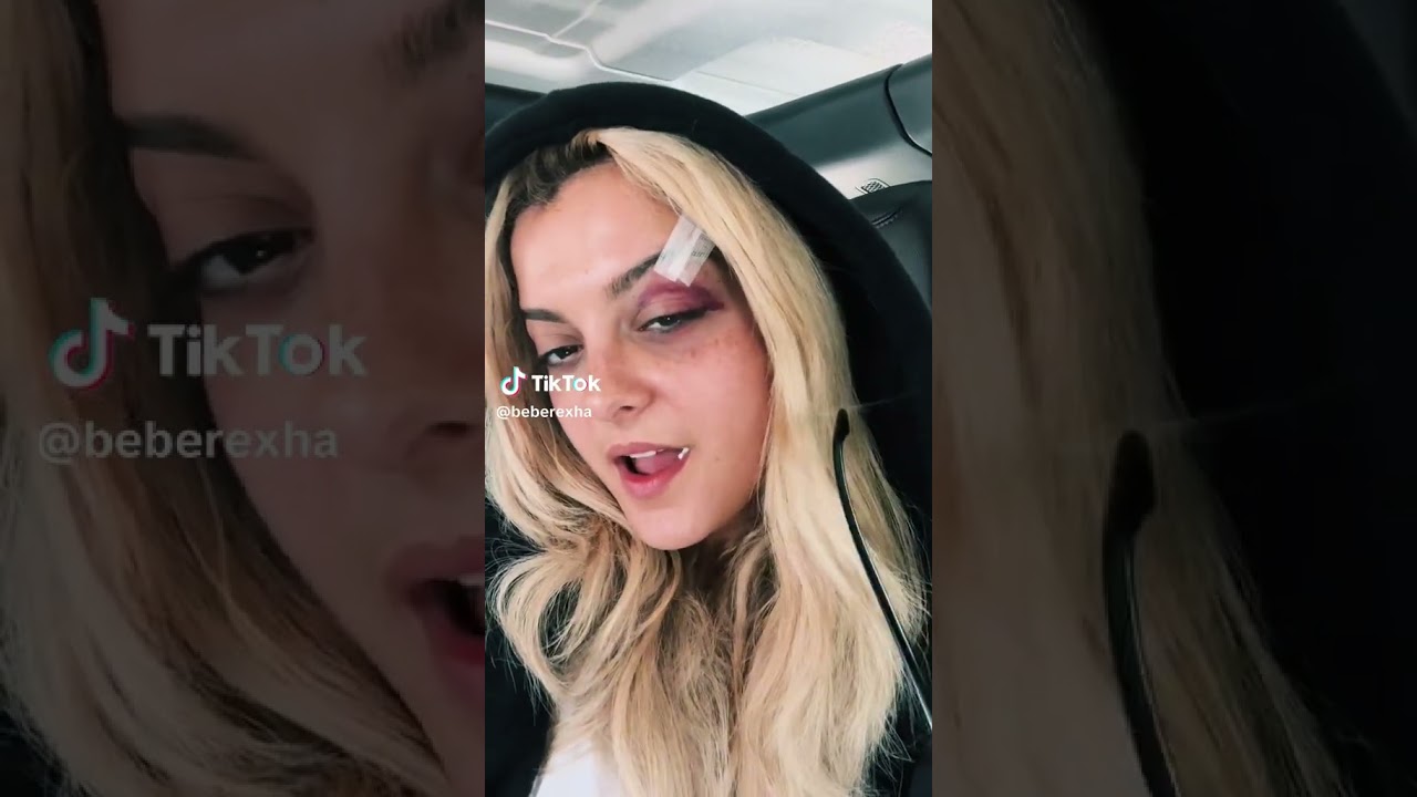 Bebe Rexha shows her injury after the hit of a phone during her show