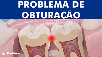 Como é feita a obturação do dente?