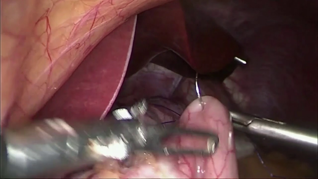 camera iphone 8 plus apk laparoscopic gastric plication for morbid obesity- Dr.Muayad Abass Fadhel