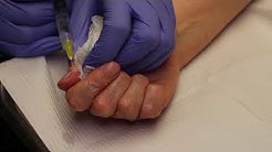 Fingernail Punch Biopsy