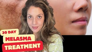 Melasma treatment at home 30 day challenge | Nipun Kapur