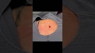 Can We Get This Forehead Steatocystoma?