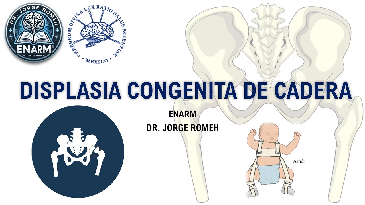 DIASPLASIA CONGENITA DE CADERA - ENARM - TODO LO QUE DEBES SABER