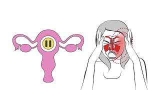 What is Sinus Migraine   Chapter 1 Migraine Types   Explainer Video Series