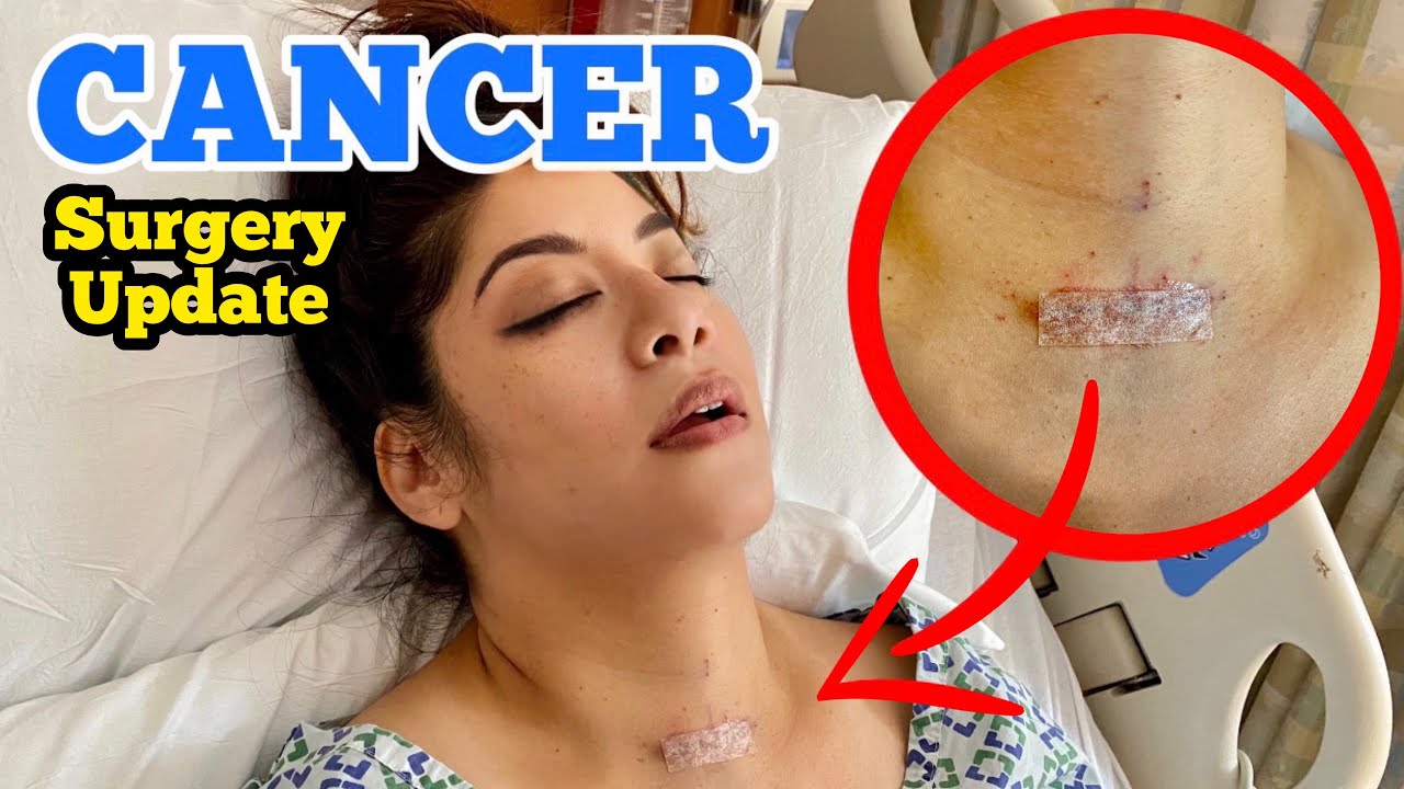 I HAVE CANCER AGAIN Surviving Thyroid Cancer Surgery CANCER SURVIVOR