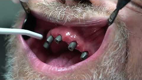 5. TRIOS Intraoral Scanner: Full arch on implants scan