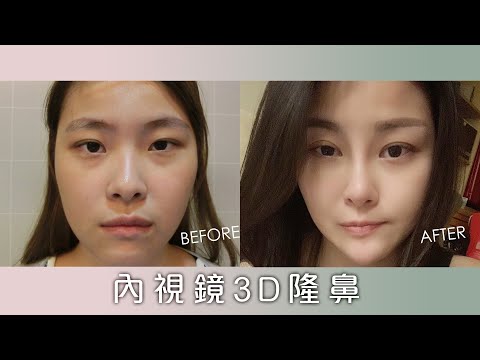 維納斯時尚診所-案例-內視鏡3D隆鼻一個月追蹤