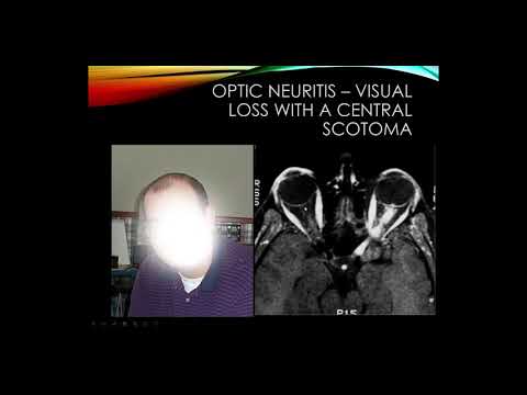 Видео: Neuromyelitis Optica (NMO) Vs. MS: Как тези условия се сравняват