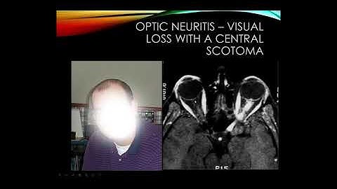Multiple Sclerosis and Neuromyelitis Optica