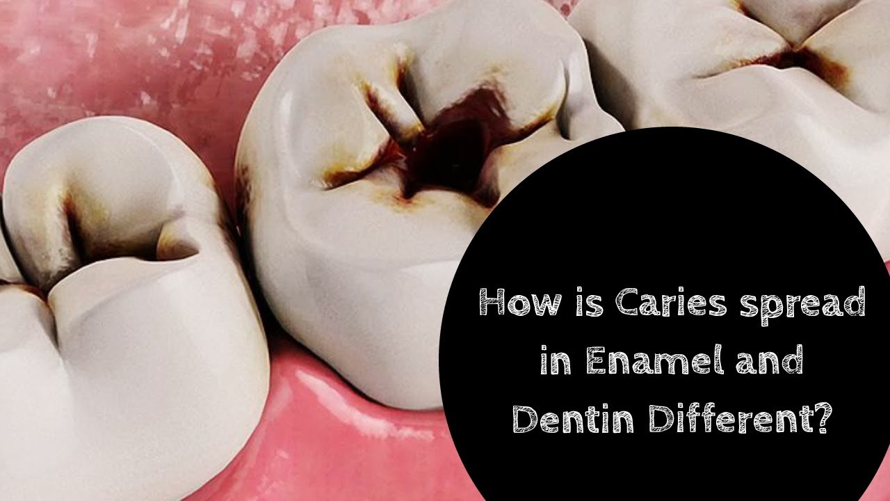 Spread of Caries in Enamel and DentinASPIRE MDS NEET AIIMS MDS