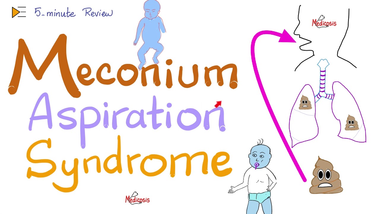 Meconium Aspiration Syndrome (MAS) | 5-Minute Review