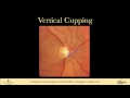 9 EXAMINATION Optic Nerve Head and Nerve Fiber Layer Changes in Glaucoma