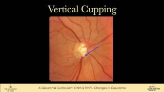 9 EXAMINATION Optic Nerve Head and Nerve Fiber Layer Changes in Glaucoma