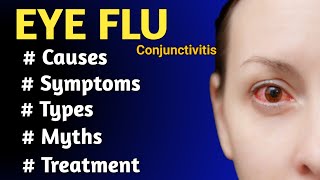 EYE FLU or Conjunctivitis | Causes, Symptoms and Treatment | Eye flu kaise hota hai |