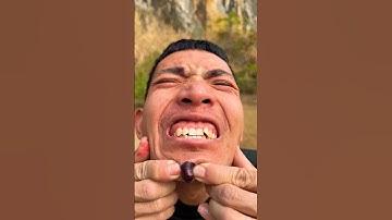 How I Cured a Bug Bite with Yogurt in the Wild.😨😰#comedy #shorts