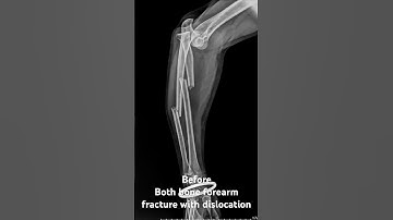 Both bone forearm plating#orthopaedicsurgeon #fracture #bones  #hospital #healing #thegooddoctor
