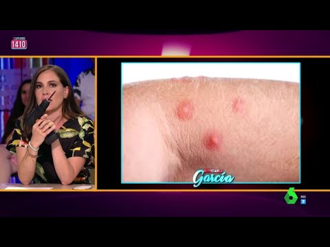 Video: ¿Son peligrosas las picaduras de pulgas?