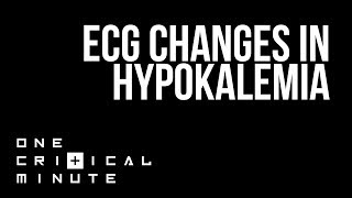 ECG Changes in Hypokalemia - One Critical Minute [1CM]