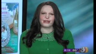 Burn Survivor Stephanie Nielson On Ktvk3