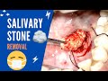 Salivary duct stone – Sialolithiasis - How to treat?