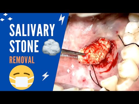 Salivary duct stone – Sialolithiasis - How to treat?