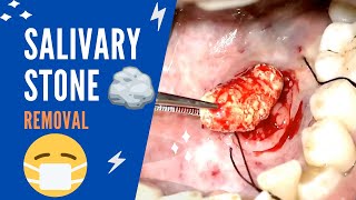 Salivary duct stone – Sialolithiasis - How to treat