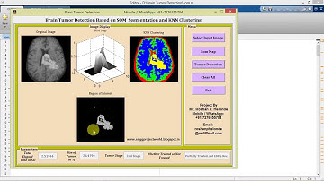 Brain Tumor Detection Using Segmentation Matlab Project with Source Code