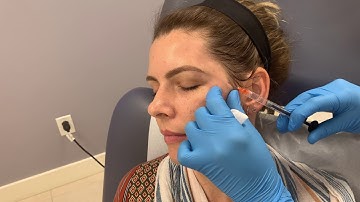Treating temple volume loss using Restylane Refyne and a microcannula
