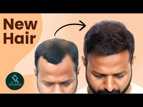 Hair Growth Every Month Looks Better & Better 🤯 | Hair Transplant in Kolkata | New Roots