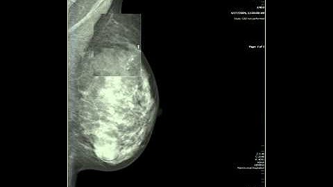Breast Imaging Boot Camp: Calcifications