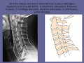 Anatomia radiologica de la columna vertebral