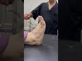 حالة سقوط بالقدم بعد عملية المنظار 