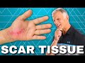 How to Get Rid of Scar Tissue After Surgery or Injury (Hardened?)