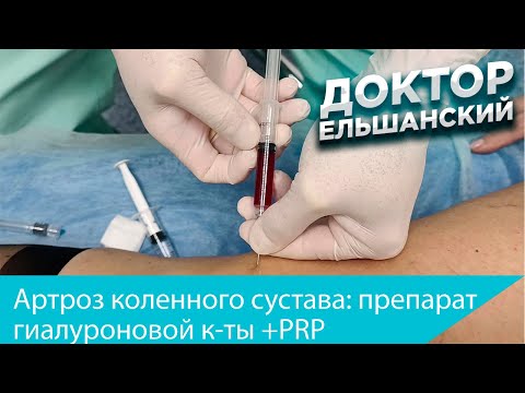 Лечение артроза коленного сустава - препарат гиалуроновой кислоты + PRP