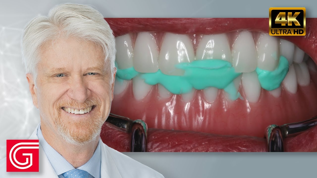 Restoration of Implant Overdentures by Timothy Kosinski DDS MAGD