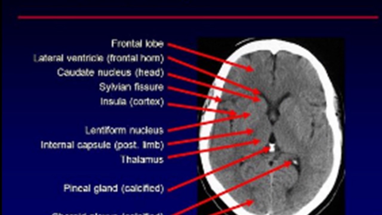 Basal Ganglia Anatomy Ct