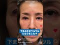 他院で脱脂サレすぎた方の修正術後　オキュロフェイシャルクリニック鹿嶋友敬 #オキュロフェイシャルクリニックグループ #美容 #美容整形