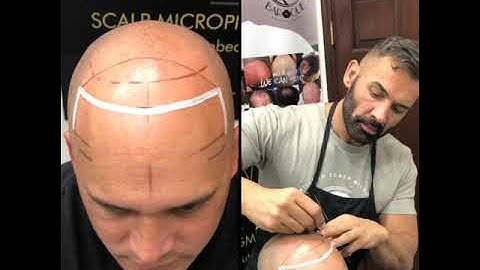 Scalp Micropigmentation step by step with Antonio Baroque @ BAROQUE BEAUTY CENTER