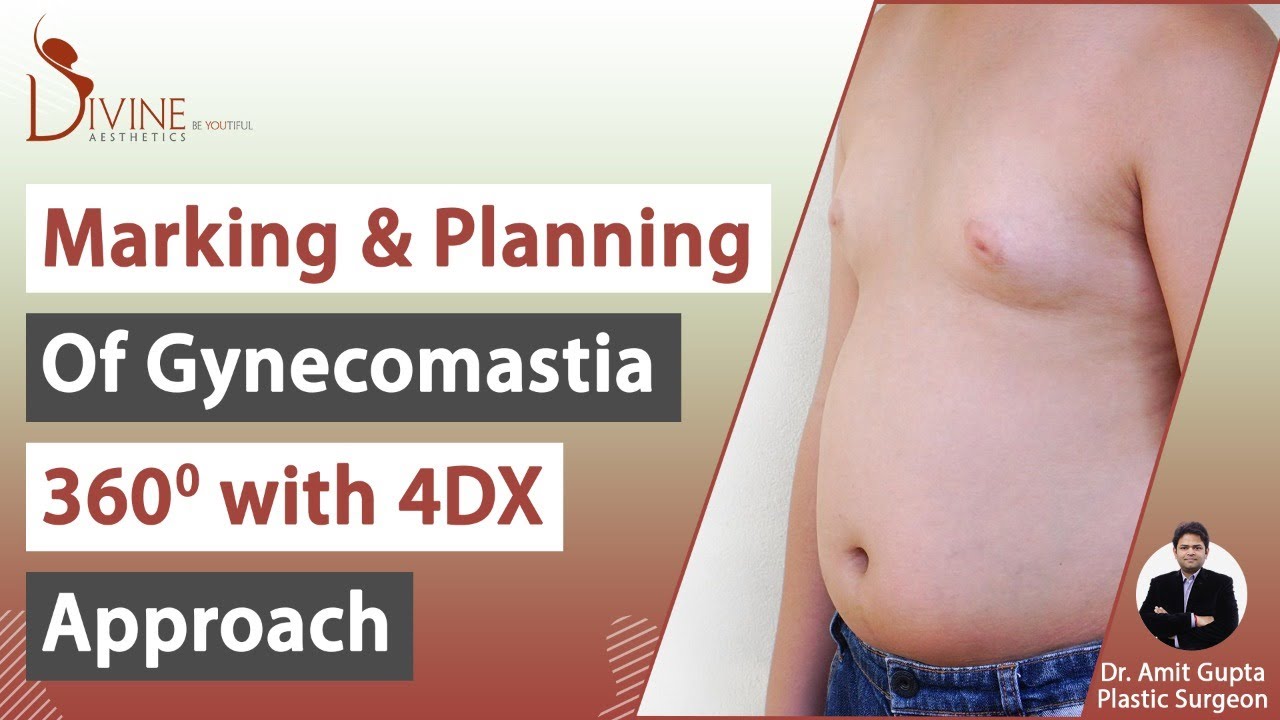 Marking & Planning of Gynecomastia 360 Degree with 4DX Approach - YouTube