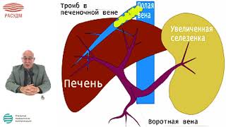 Ультразвуковая диагностика портальной гипертензии у детей