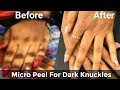 Micro Peel For Dark Knuckles