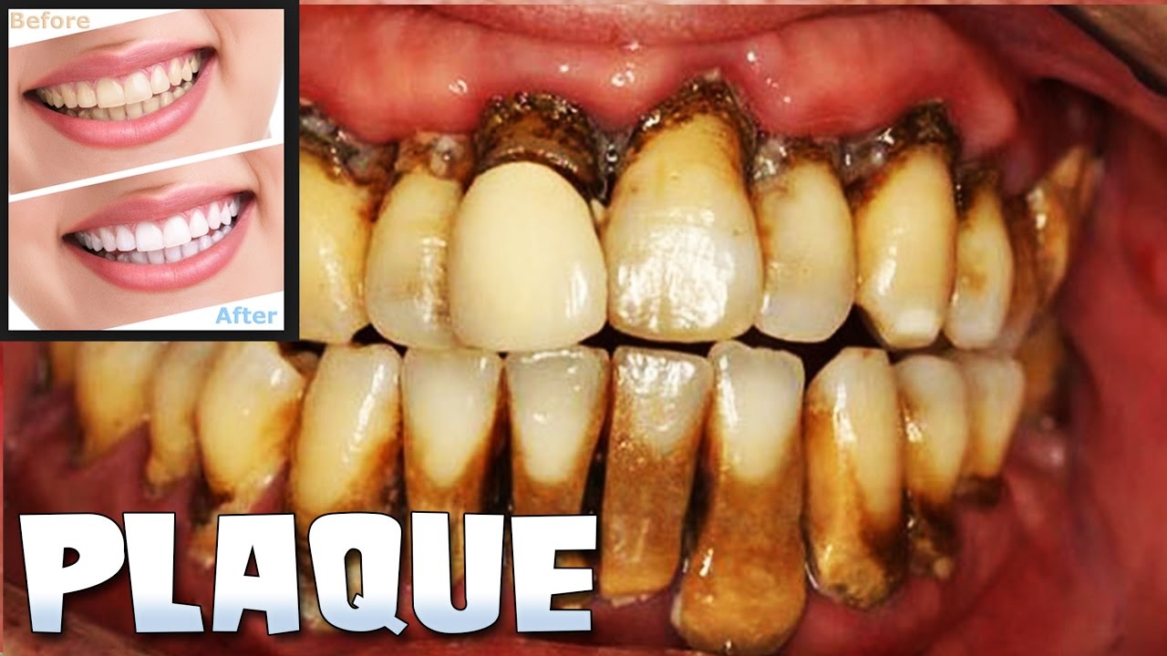 Dental Plaque, Tooth Cleaning & Teeth Whitening! - YouTube