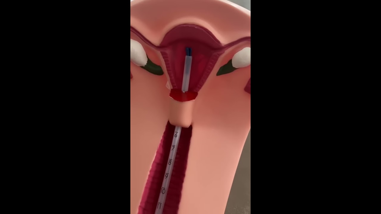 IUD Insertion