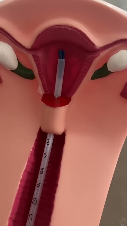 IUD Insertion