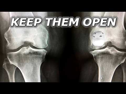 How To Stop Growth Plates From Closing Prematurely (Real Science, No Cope)