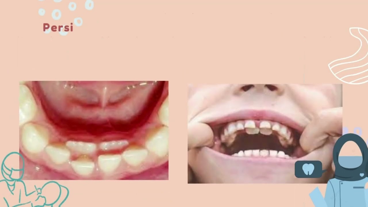 VIDEO EDUKASI GIGI   PERSISTENSI DAN PENCABUTAN GIGI SULUNG