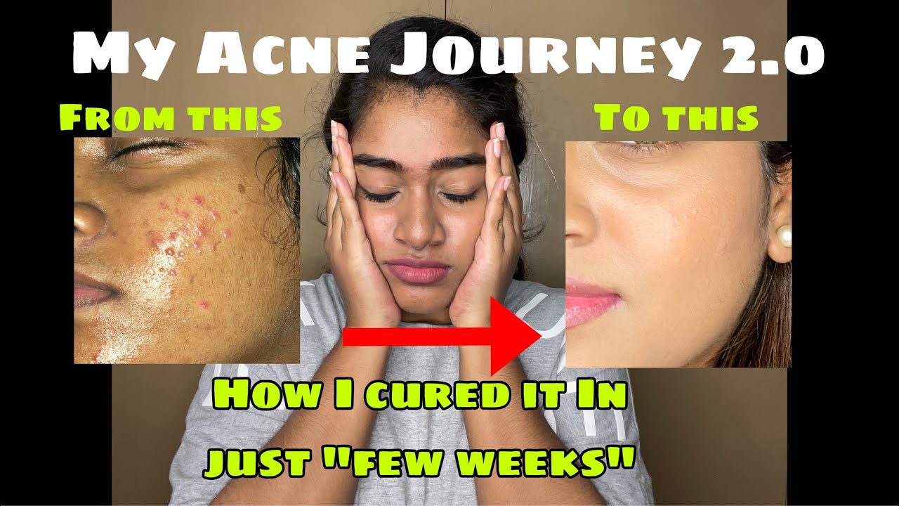 My Acne Journey 2.0 | How I cured acne in just few weeks | Products to treat acne & pimples